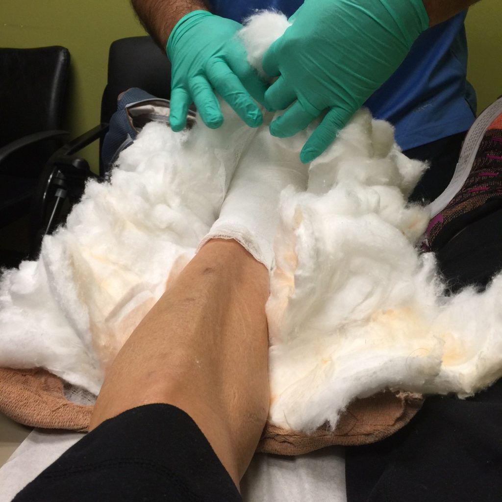 lisfranc injury