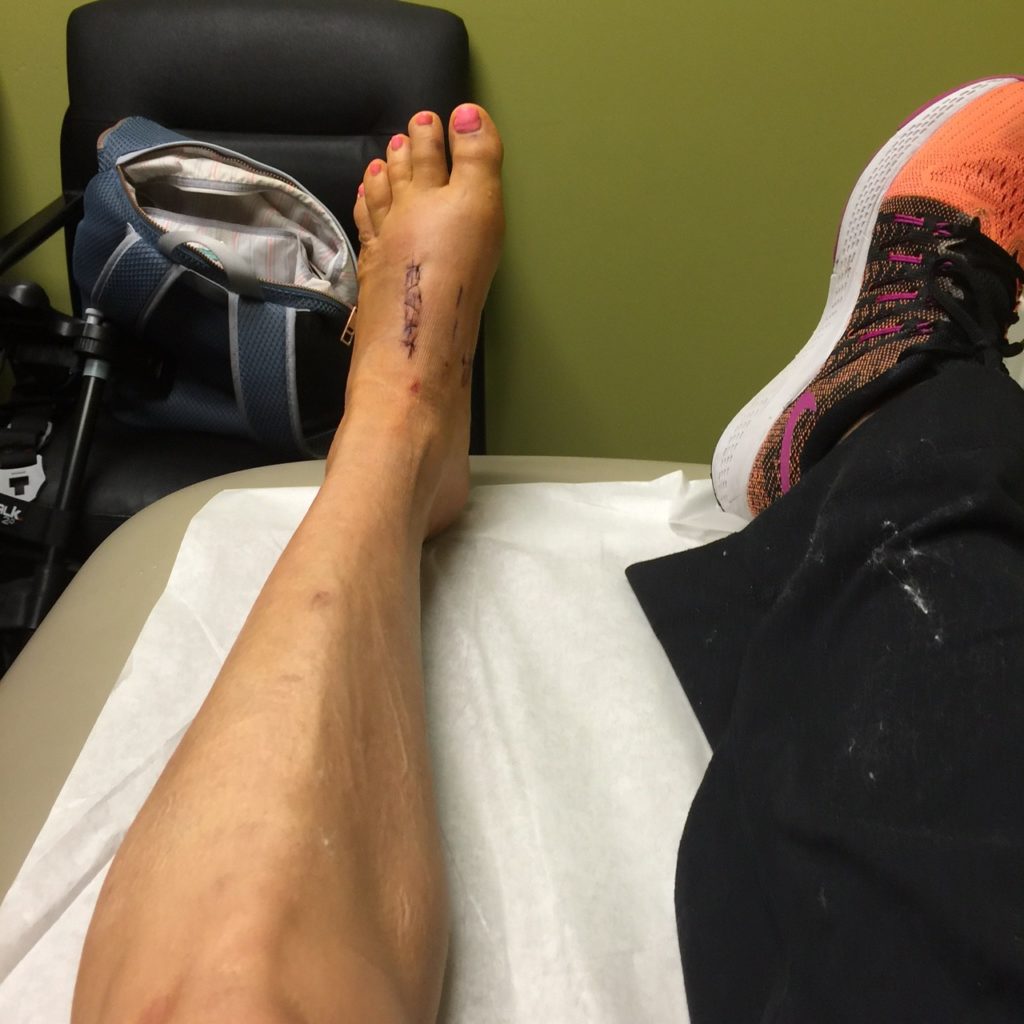 lisfranc injury
